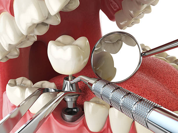 Best Chipped Tooth Repair Near Me  in Royse City, TX
