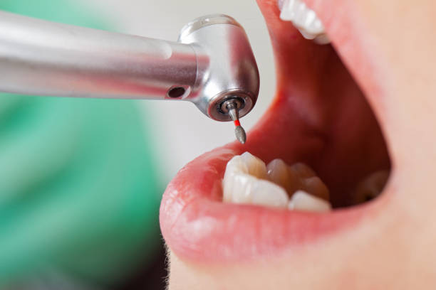 Best Emergency Tooth Extraction  in Royse City, TX